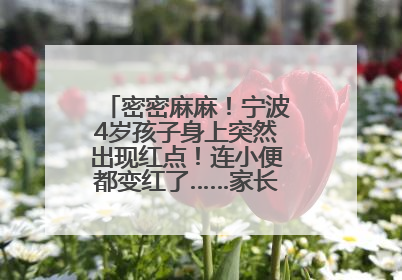 密密麻麻！宁波4岁孩子身上突然出现红点！连小便都变红了……家长：以为只是摔伤